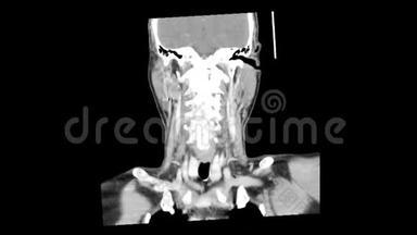 CT扫描整个颈部平滑运动